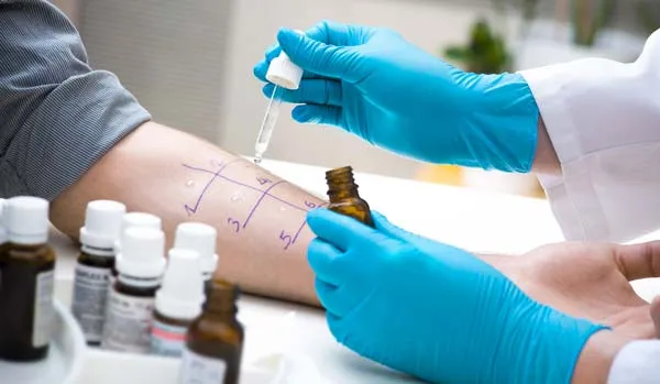 Skin Prick Allergy Test